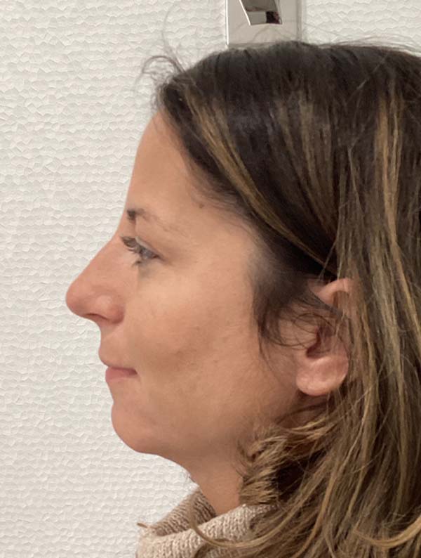 Rhinoplasty case #3934