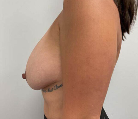 Breast Implant Revision case #3865