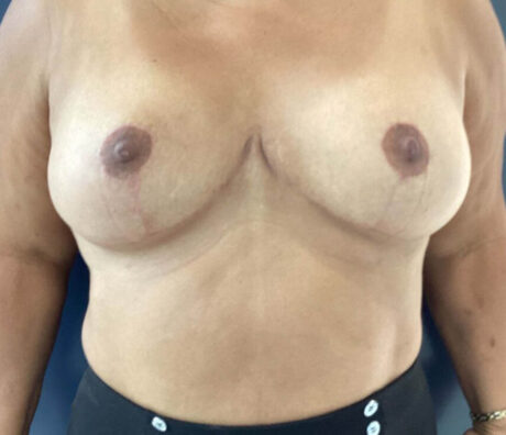 Breast Reduction case #3839