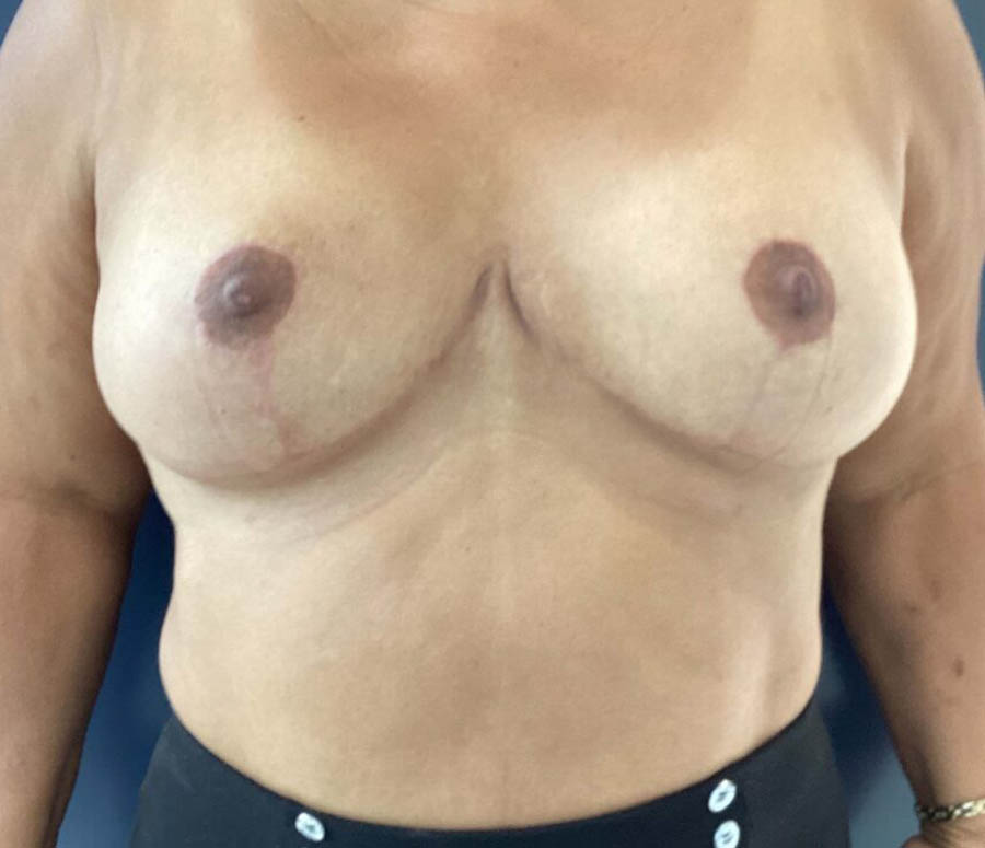 Breast Reduction case #3839
