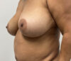 Breast Reduction case #3839