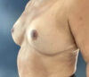 Breast Reduction case #3839