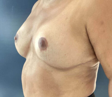 Breast Reduction case #3839