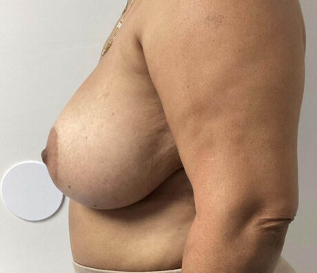 Breast Reduction case #3839