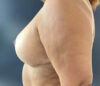 Breast Reduction case #3839