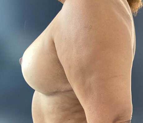 Breast Reduction case #3839