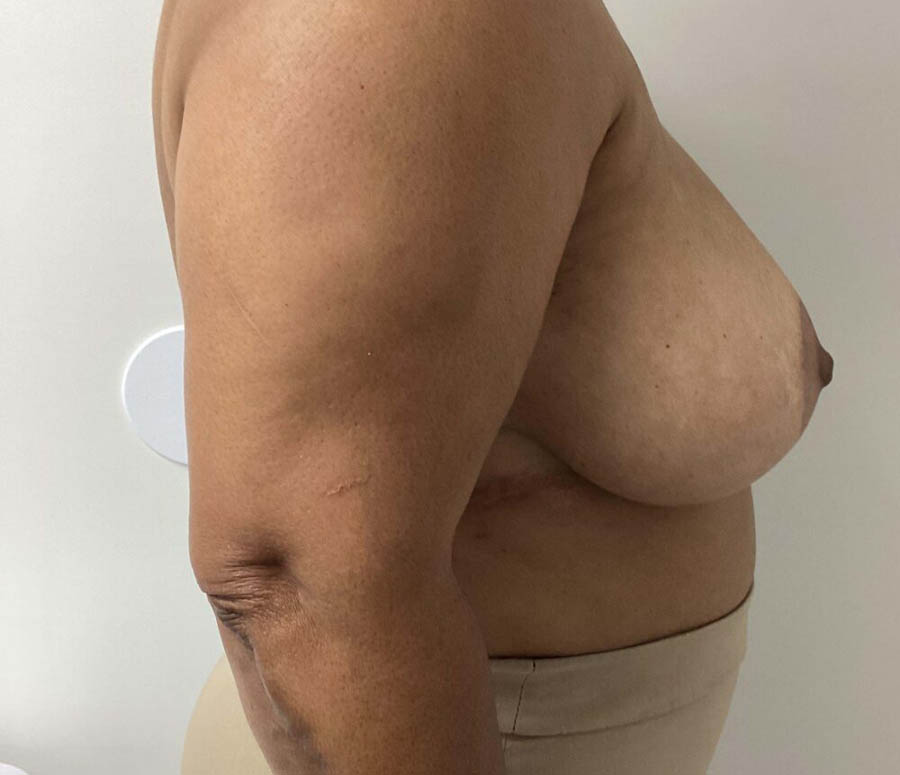 Breast Reduction case #3839