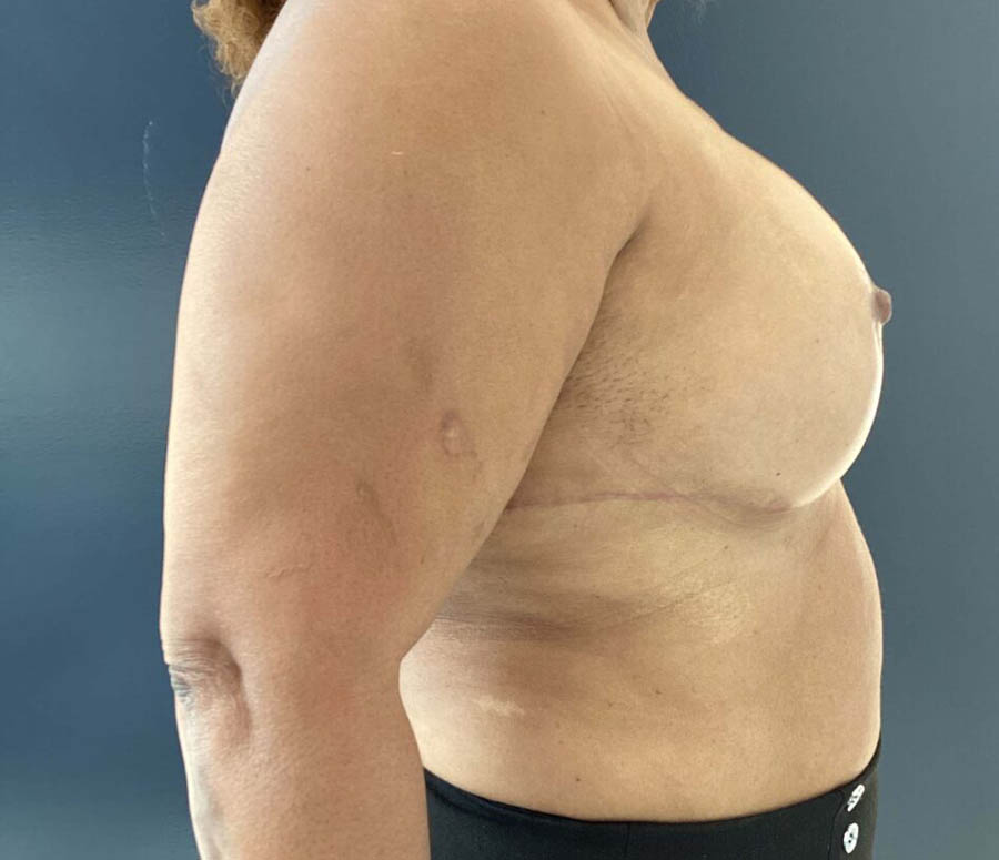 Breast Reduction case #3839