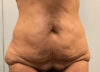 Tummy Tuck case #3953