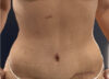 Tummy Tuck case #3953