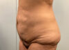 Tummy Tuck case #3953