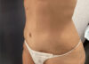 Tummy Tuck case #3953