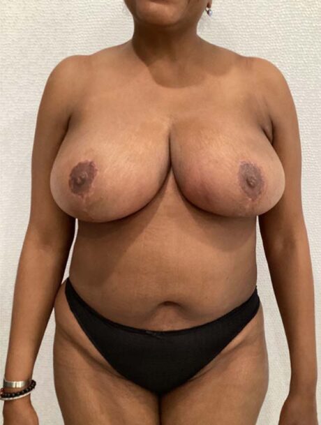 Breast Reduction and Lift case #3872