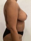 Breast Reduction and Lift case #3872
