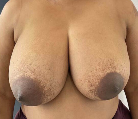 Breast Reduction case #3895