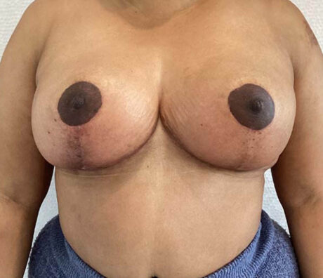 Breast Reduction case #3895