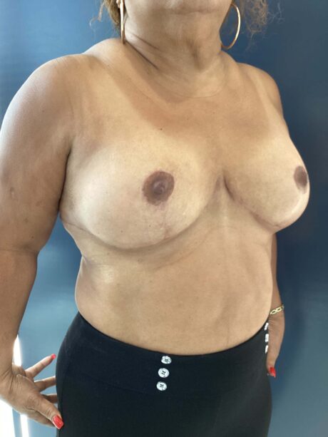 Breast Reduction and Lift case #3839