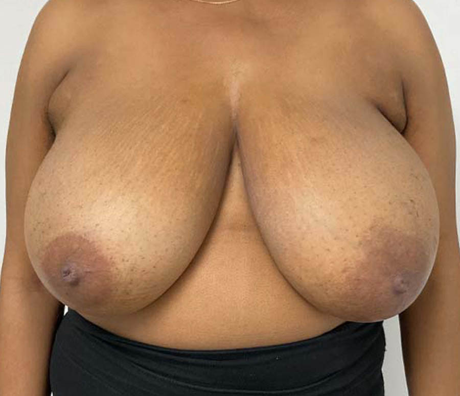 Breast Reduction case #3872