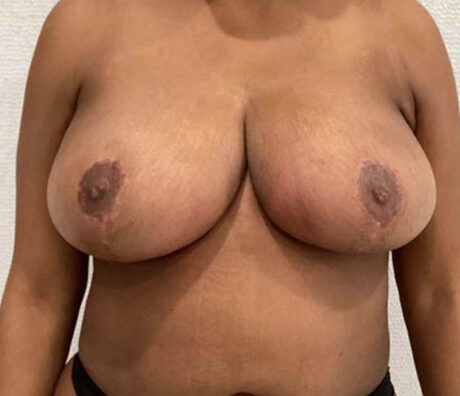Breast Reduction case #3872