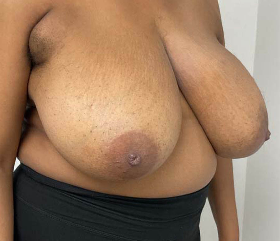 Breast Reduction case #3872