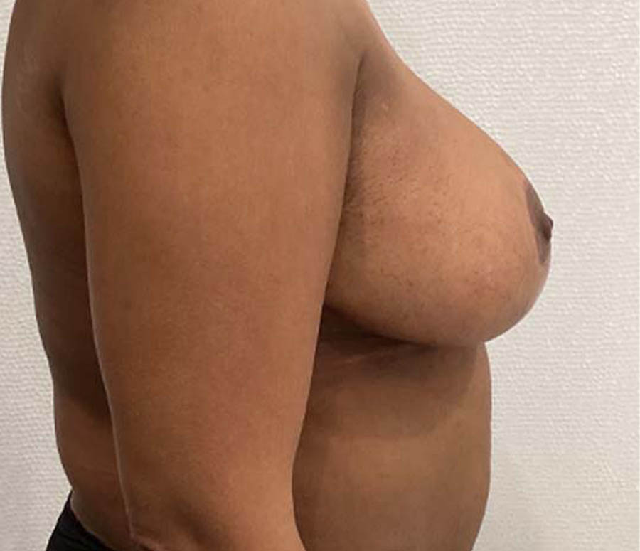 Breast Reduction case #3872