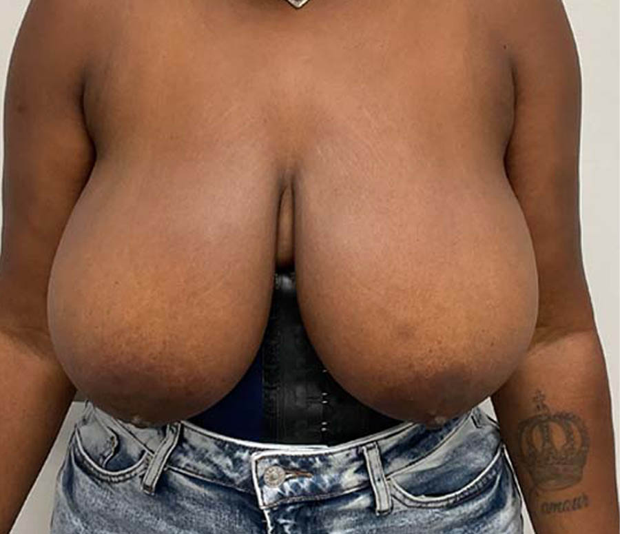 Breast Reduction case #3884