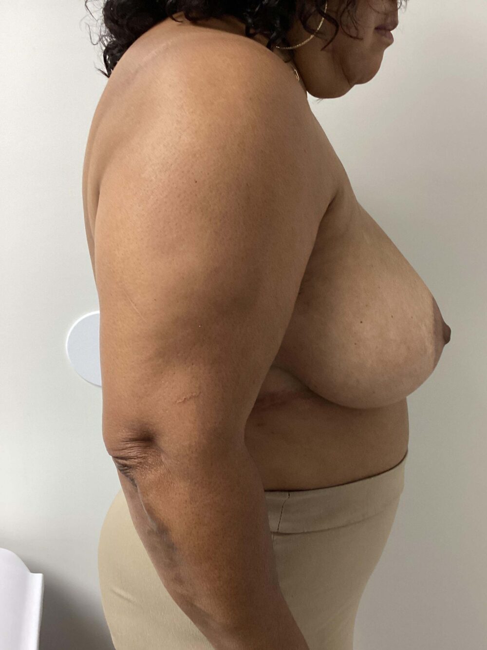 Breast Reduction and Lift case #3839