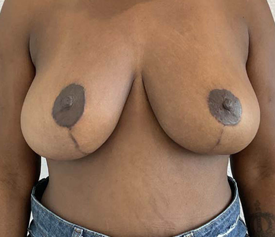 Breast Reduction case #3884