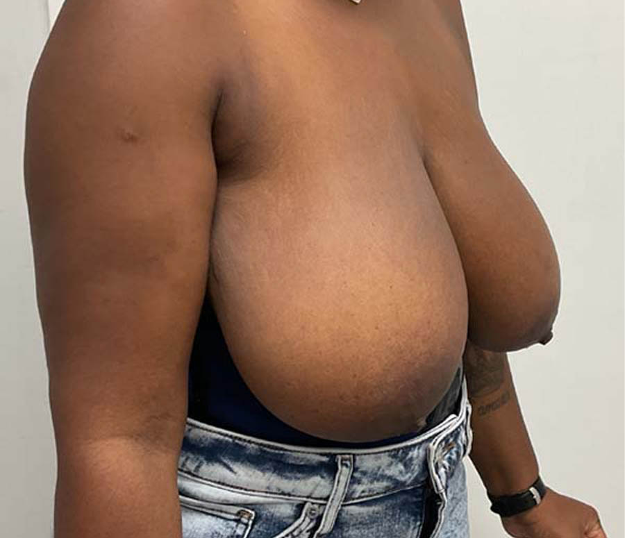 Breast Reduction case #3884