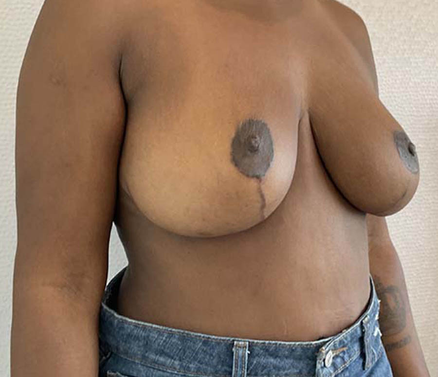 Breast Reduction case #3884