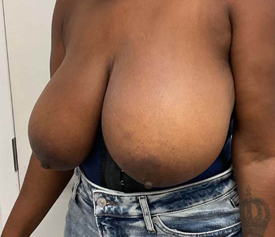 Breast Reduction case #3884