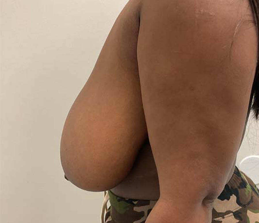 Breast Reduction case #3884