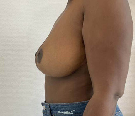 Breast Reduction case #3884