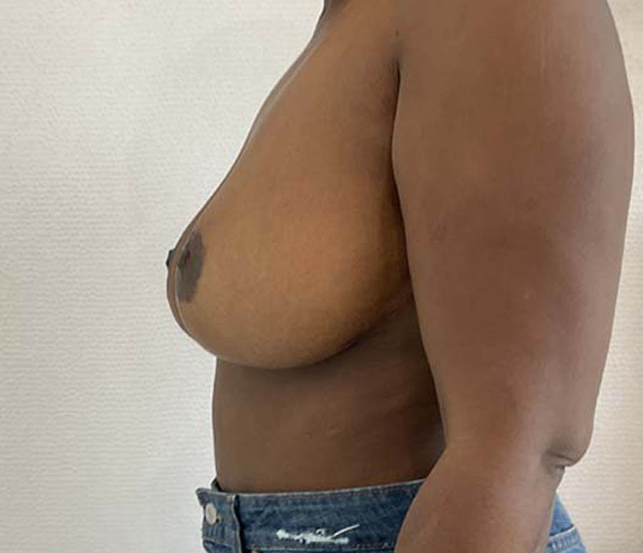 Breast Reduction case #3884