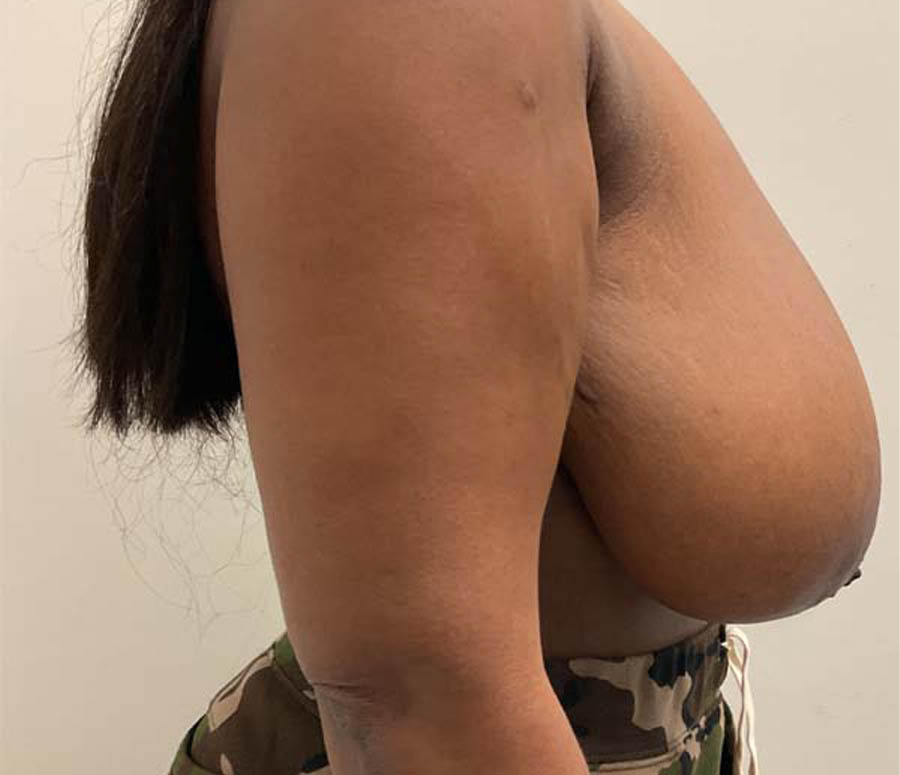 Breast Reduction case #3884