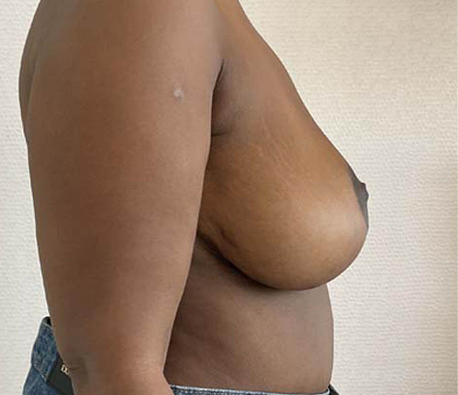 Breast Reduction case #3884