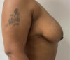 Breast Reduction case #3877