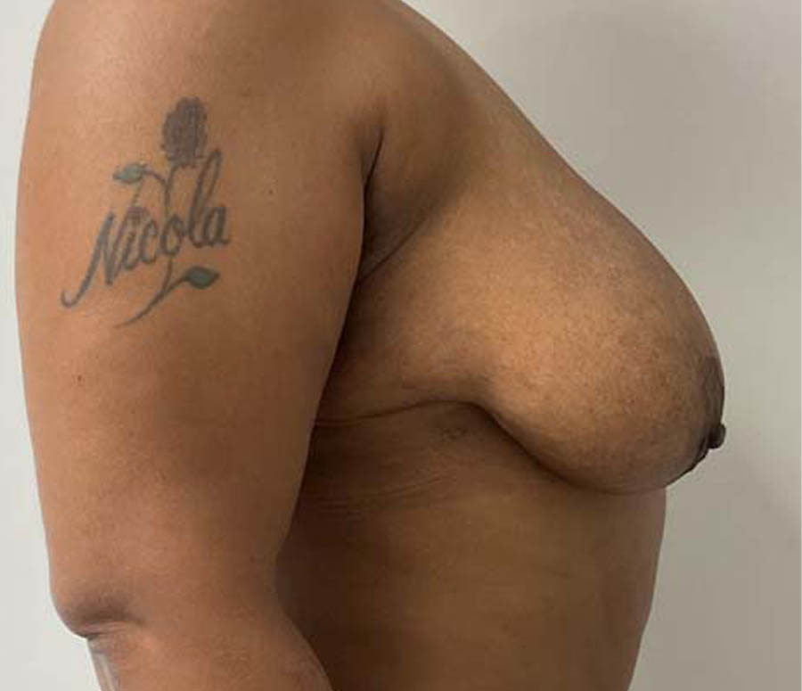 Breast Reduction case #3877