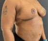 Breast Reduction case #3877