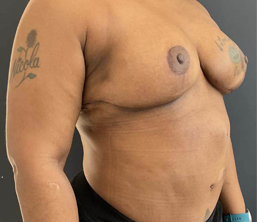 Breast Reduction case #3877