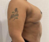 Breast Reduction case #3877