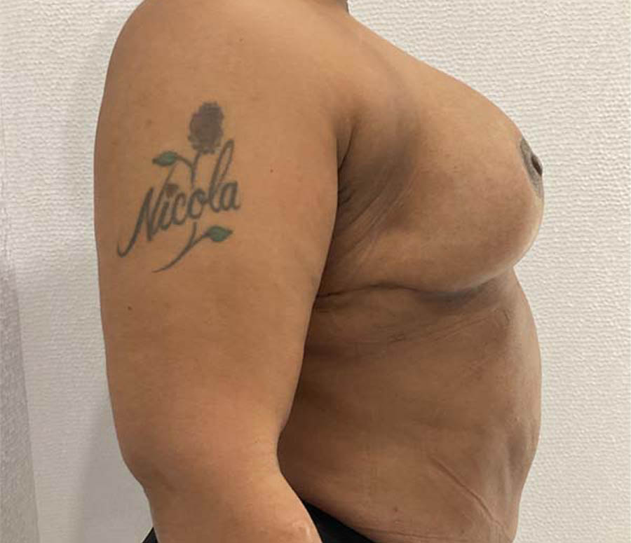 Breast Reduction case #3877