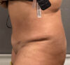 Liposuction case #5886