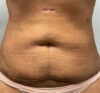 Liposuction case #5670