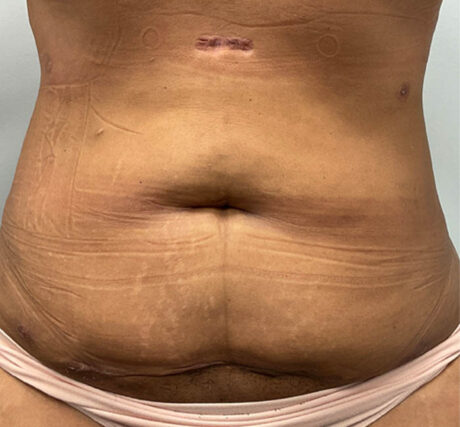 Liposuction case #5670