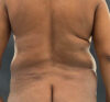 Liposuction case #5671