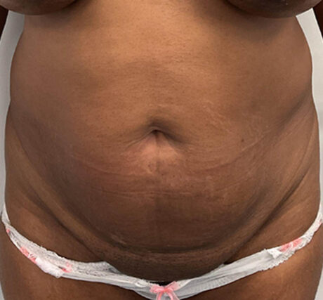 Liposuction case #5879