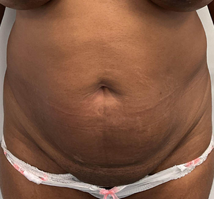 Liposuction case #5879