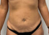Tummy Tuck case #6101