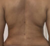 Liposuction case #5700